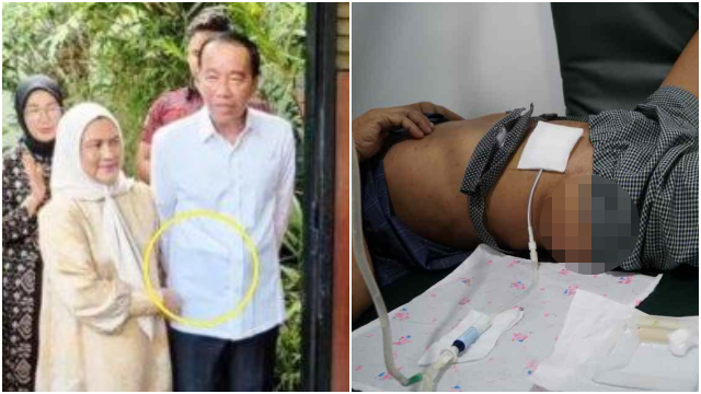 Apa Itu CAPD? Jokowi Disebut Pakai Alat Kesehatan Khusus di Perut saat Ultah ke-64