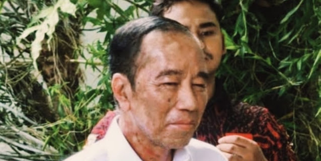 Sakit Kulit Jokowi Akibat Stres Berat