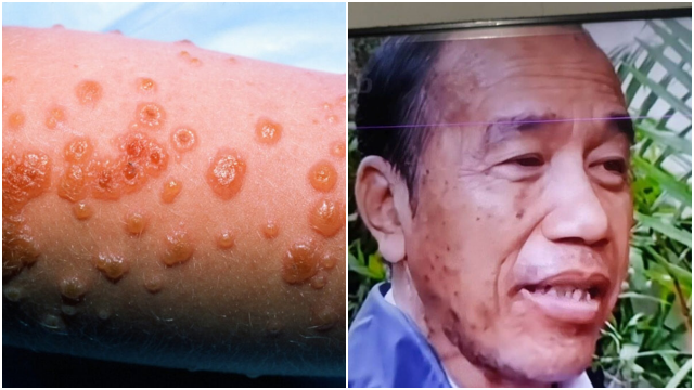 Diduga Idap Sindrom Langka, Jokowi Jalani Perawatan Intensif