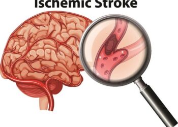 stroke-iskemik | INFOACEH.net Stroke Serang Perokok di Banda Aceh, RSUD Meuraxa Tangani Kasus Pertama Code Stroke