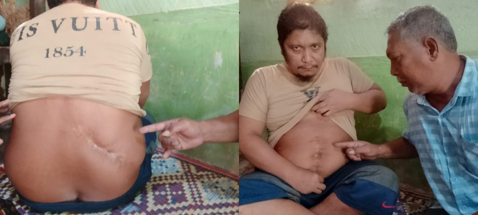Salah satu korban pelanggaran HAM berat Aceh, Muhammad Syukur, korban selamat Tragedi Simpang KKA tahun 1999, yang hingga kini mengalami gangguan kejiwaan akibat luka fisik dan trauma psikis. (Foto: Ist)